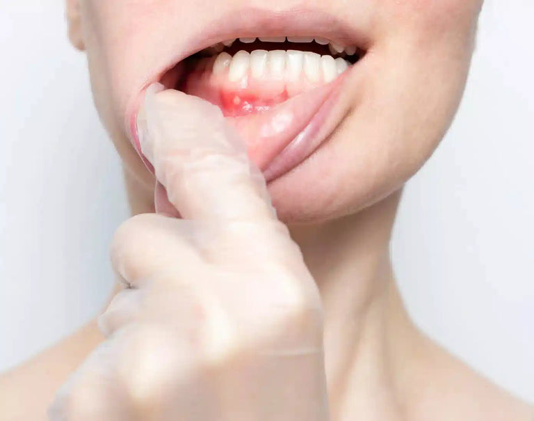 How To Spot And Treat Oral Thrush