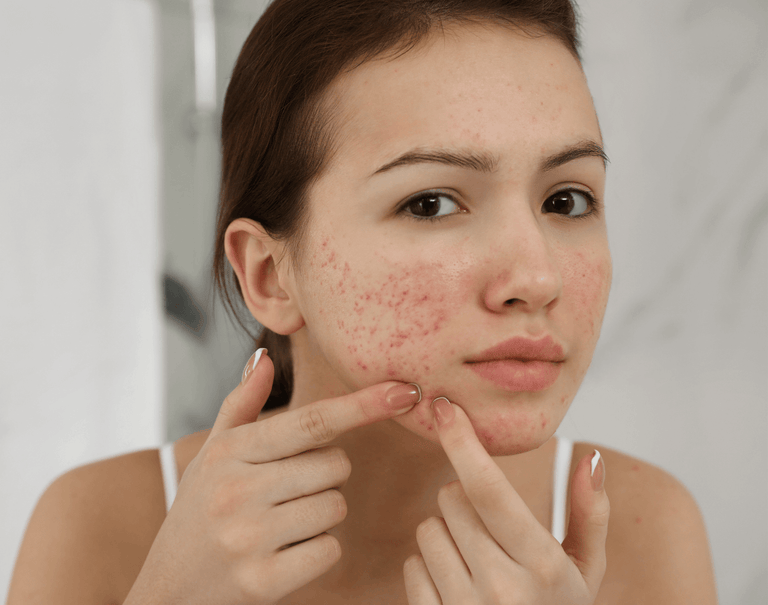 Acne Care and Advice