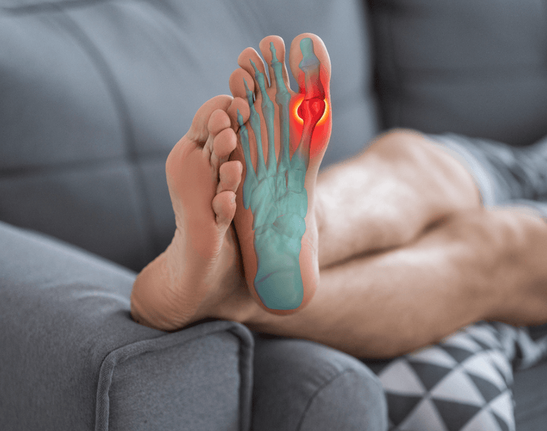 Gout Point of Care Testing